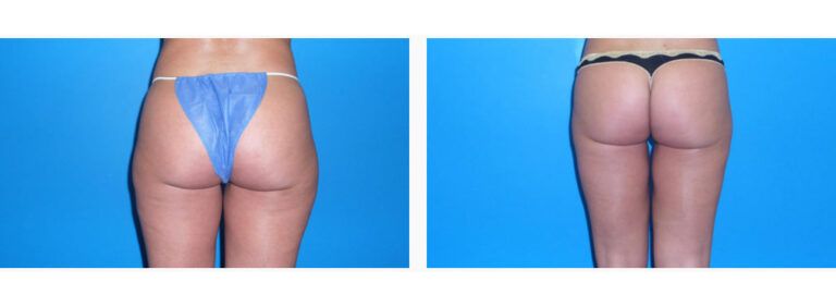 Liposuction before and after treatment