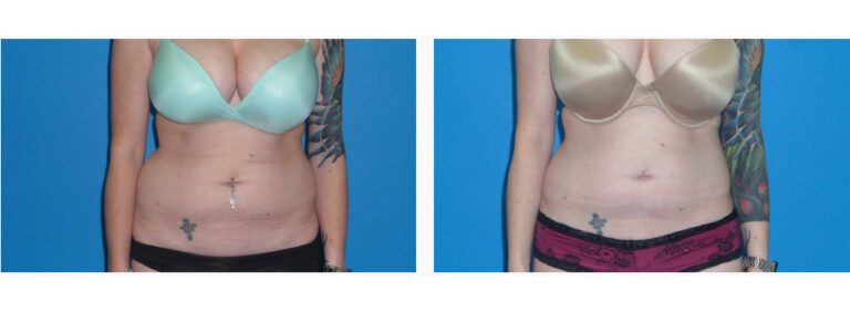 Liposuction before and after treatment