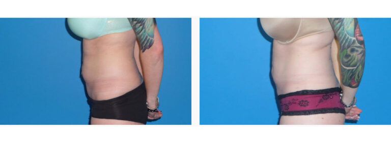 Liposuction before and after treatment