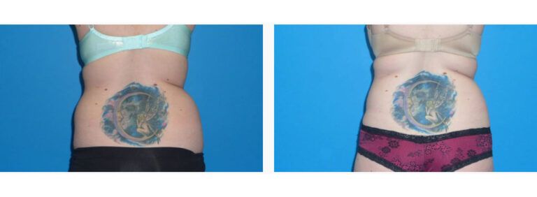 Liposuction before and after treatment