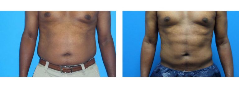 Liposuction before and after treatment