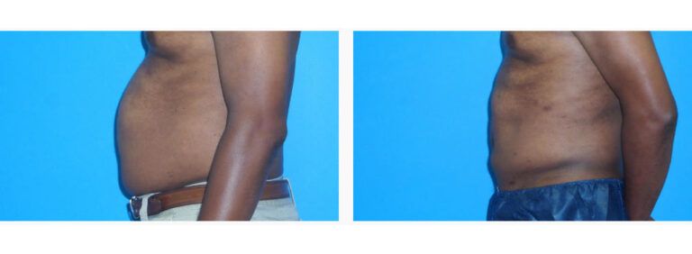 Liposuction before and after treatment