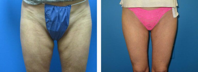 Liposuction before and after treatment
