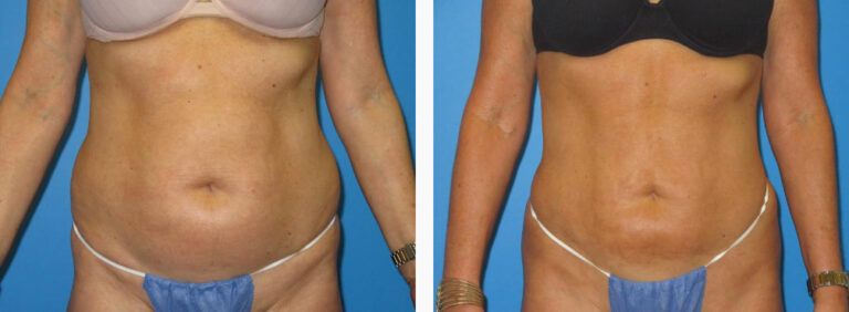 Liposuction before and after treatment