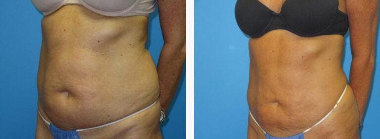 Liposuction before and after treatment