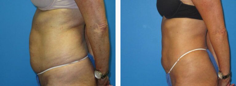 Liposuction before and after treatment