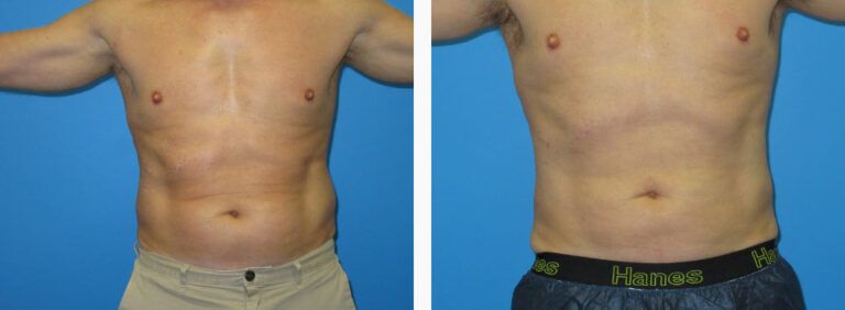 Liposuction before and after treatment