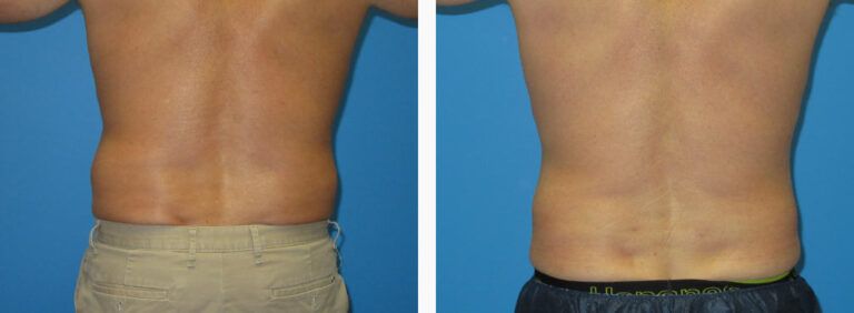 Liposuction before and after treatment