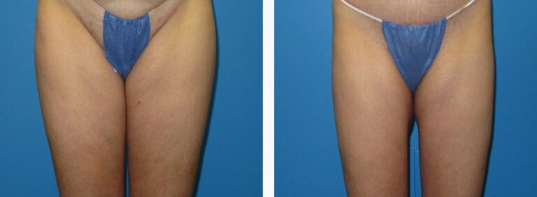 Liposuction before and after treatment