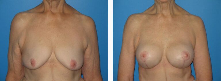 Mastopexy Case before and after treatment