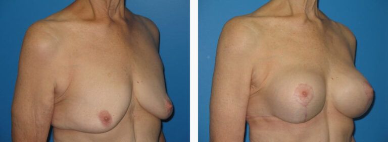 Mastopexy Case before and after treatment
