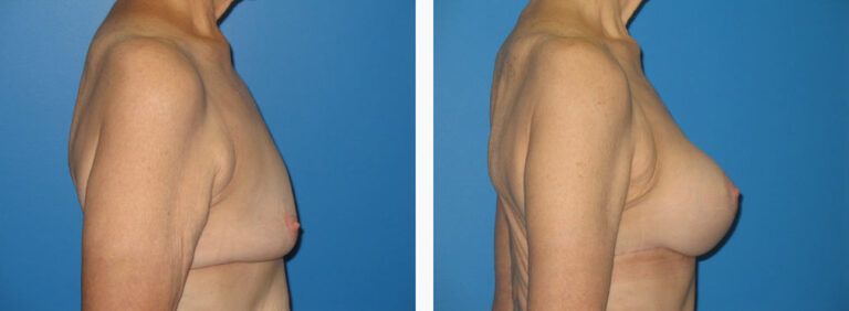 Mastopexy Case before and after treatment