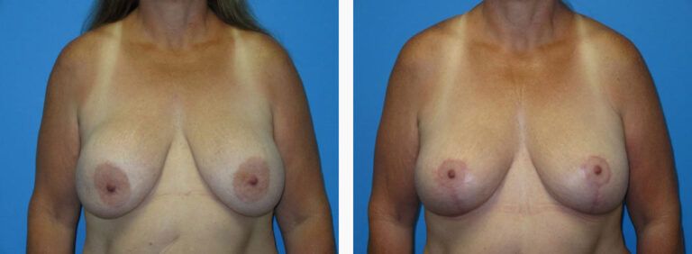 Remove and Replace w Mastopexy before and after treatment