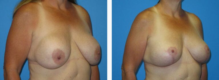 Remove and Replace w Mastopexy before and after treatment