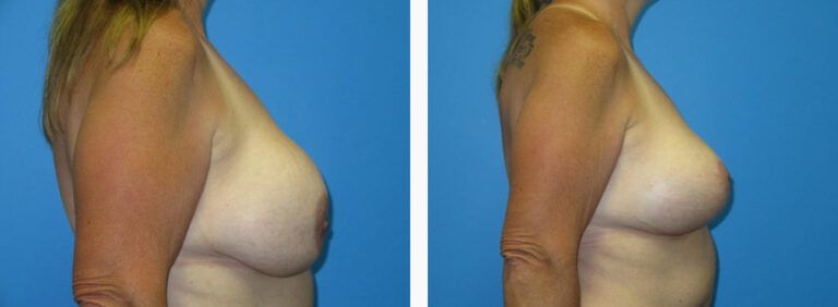 Remove and Replace w Mastopexy before and after treatment