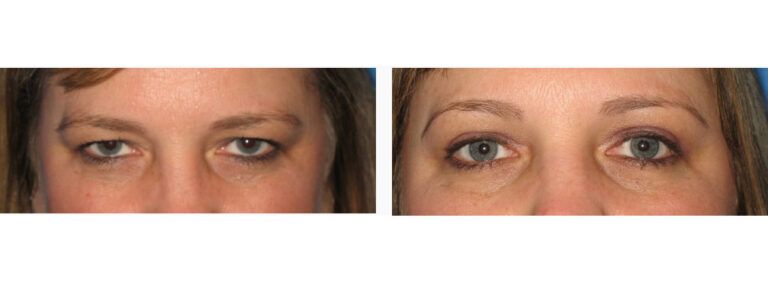 Upper Blepharoplasty before and after treatment