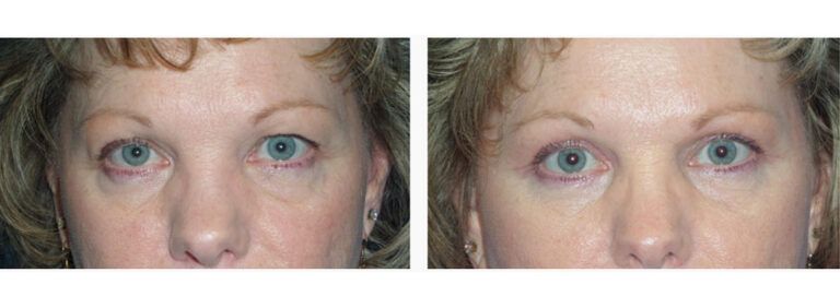 Upper Blepharoplasty before and after treatment