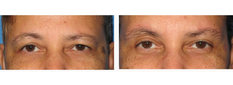 Upper Blepharoplasty before and after treatment