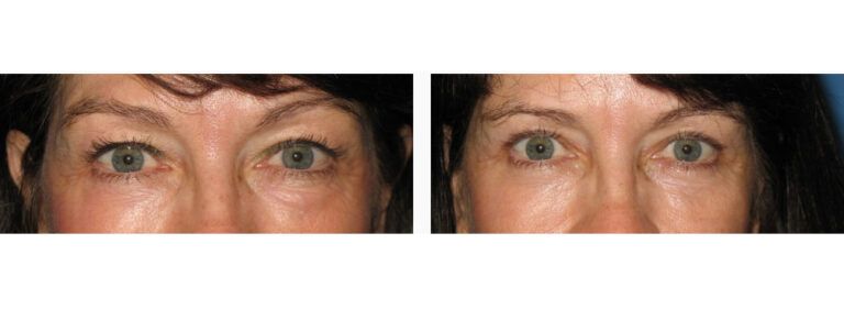Upper & Lower Blepharoplasty before and after treatment