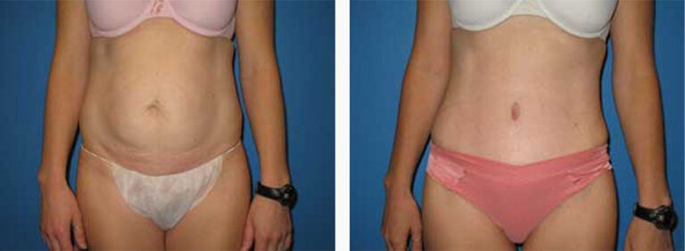 Abdominoplasty-Case-10-1