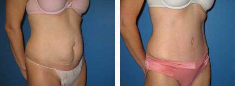 Abdominoplasty-Case-10-2