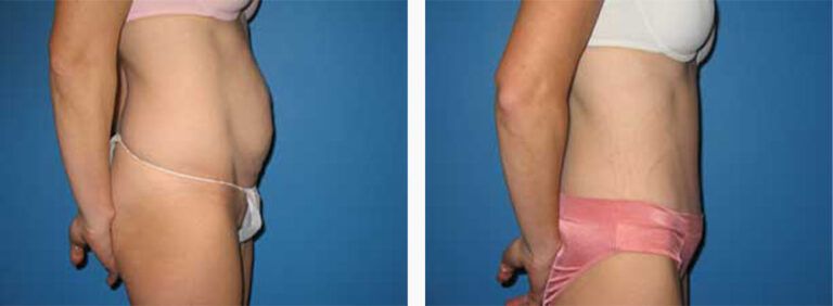 Abdominoplasty-Case-10-3