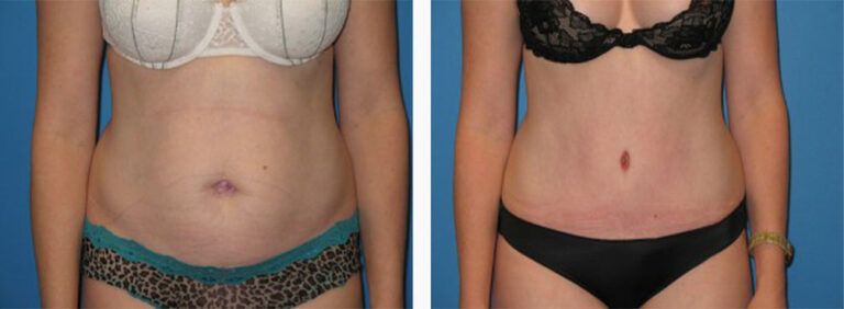 Abdominoplasty-Case-11-1