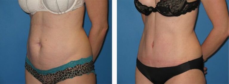 Abdominoplasty-Case-11-2