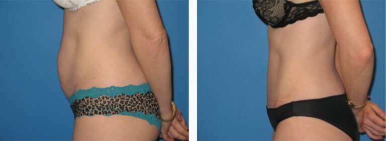Abdominoplasty-Case-11-3