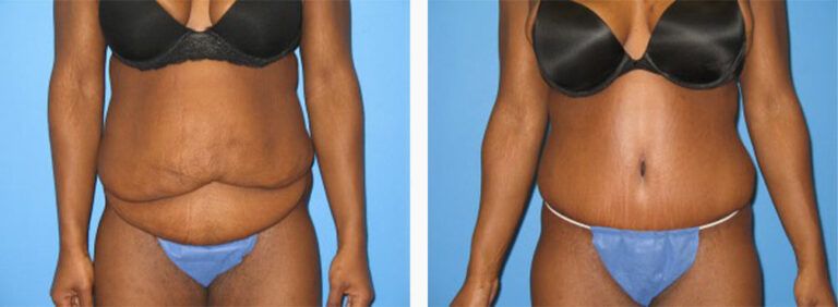 Abdominoplasty-Case-12-1