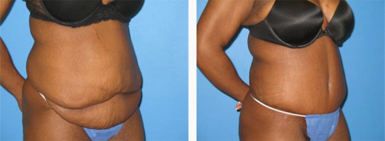 Abdominoplasty-Case-12-2