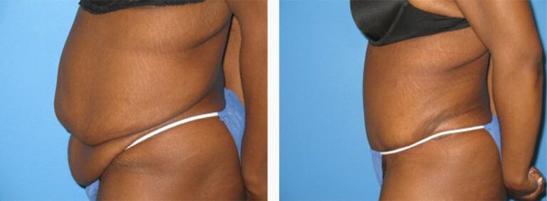 Abdominoplasty-Case-12-3