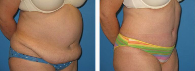 Abdominoplasty-Case-13-2