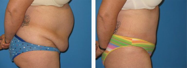 Abdominoplasty-Case-13-3