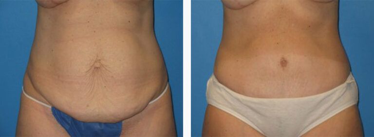 Abdominoplasty-Case-14-1