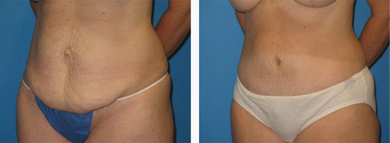 Abdominoplasty-Case-14-2