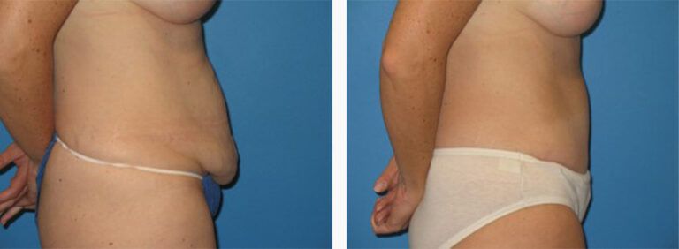 Abdominoplasty-Case-14-3