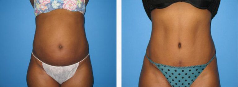 Abdominoplasty-Case-15-1