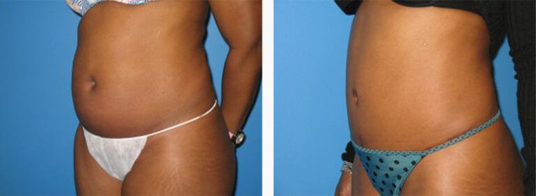 Abdominoplasty-Case-15-2
