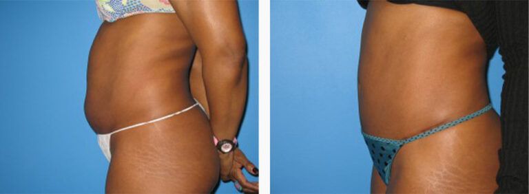 Abdominoplasty-Case-15-3