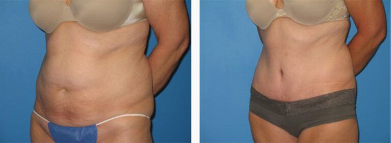 Abdominoplasty-Case-16-1
