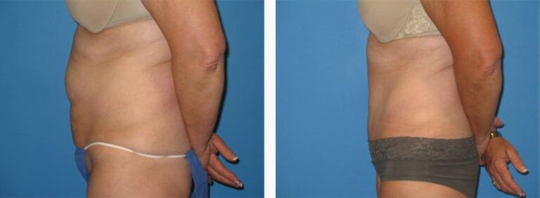 Abdominoplasty-Case-16-2