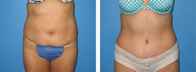 Abdominoplasty-Case-17-1