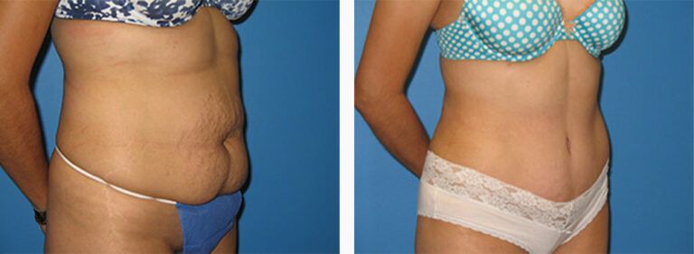 Abdominoplasty-Case-17-2