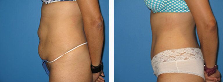 Abdominoplasty-Case-17-3