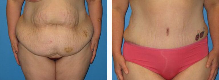 Abdominoplasty-Case-18-1