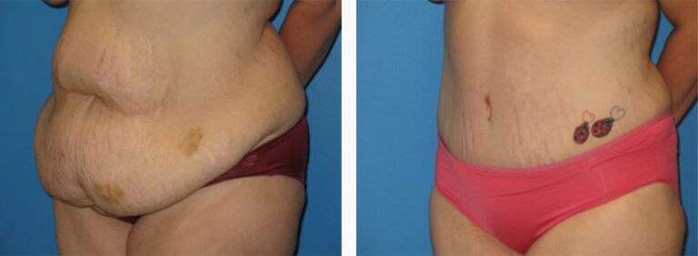 Abdominoplasty-Case-18-2