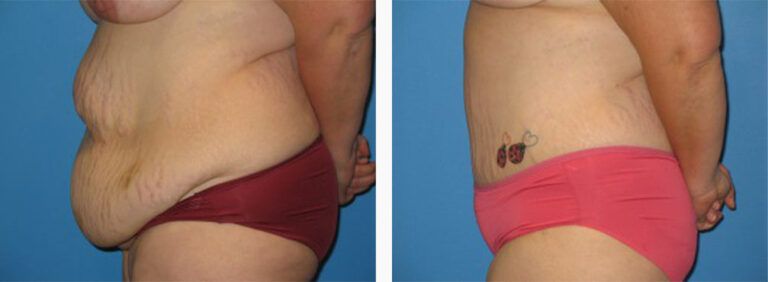 Abdominoplasty-Case-18-3