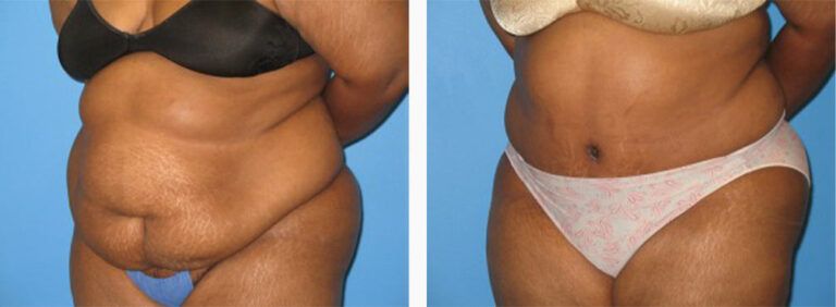 Abdominoplasty-Case-19-1
