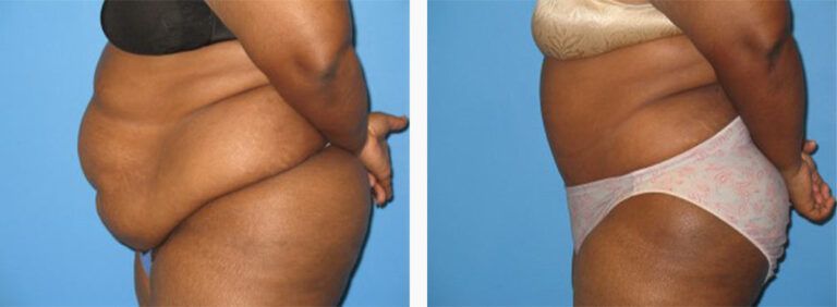 Abdominoplasty-Case-19-2